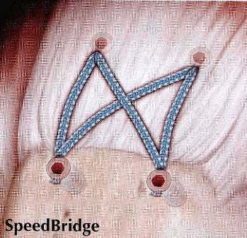 Beispiel einer modernen arthroskopischen Nahttechnik (Bild der Firma Arthrex)